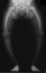 50da3-230px-xrayricketslegssmall